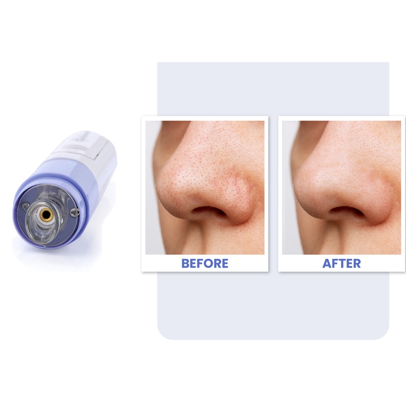 Electric Blackhead Remover & Pore Cleanser x1